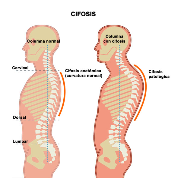 Esquema de la cifosis o joroba provocada por la osteoporosis