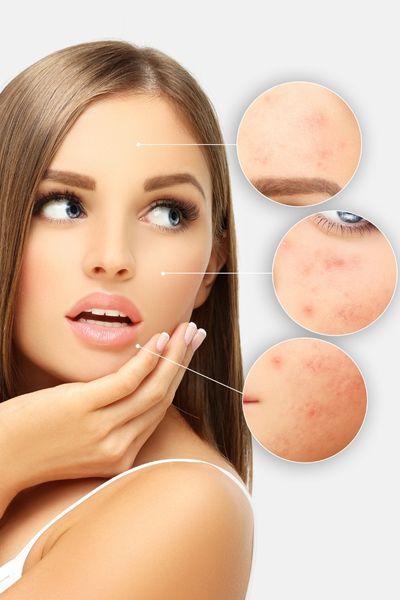 5 Estrategias para controlar el acné