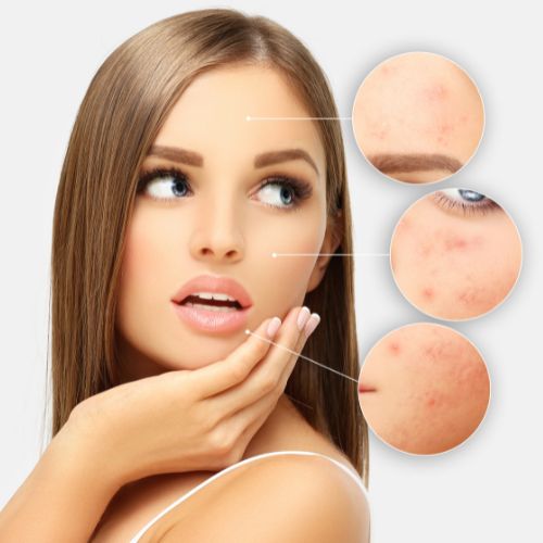 5 Estrategias para controlar el acné
